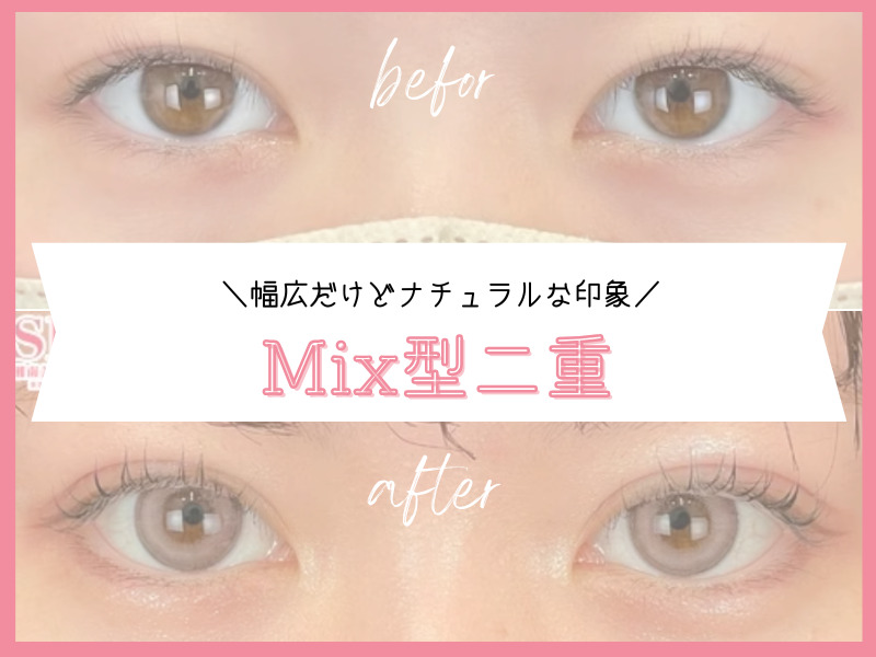 福岡　二重デザイン　Mix型